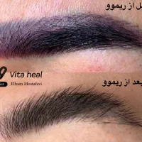خدمات و آموزش تخصصی ریموو تتوهای قدیمی