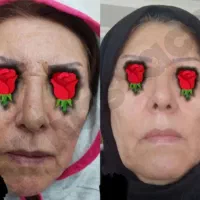 کرم بیوممتیک بوتاکس + جایگزین اصلی تزریق بوتاکس