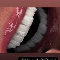 کامپوزیت دندان بدون تراش با ضمانت  ۵ ساله