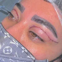 عمل پلک بالا بلفاروپلاستی|خدمات آرایشگری و زیبایی|شیراز, ملاصدرا|دیوار