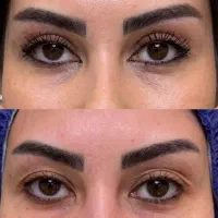 جشنواره عمل پلک فقط ۷ میلیون به مدت محدود|خدمات زیبایی و سلامت|کرمانشاه, |دیوار