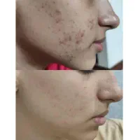 ضد لک و جوش