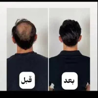 رویش مجدد مو