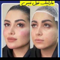 ساکشن شکم پهلو