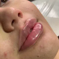 تخفیف ویژه ژل و بوتاکس