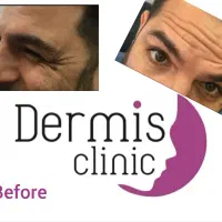 بوتاکس  فول فیس مصپورت اصلی ۵۵۰تومن بشرط اصالت|خدمات آرایشگری و زیبایی|ری, دولت‌آباد|دیوار