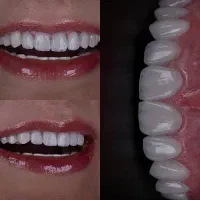 مدل کامپوزیت دندان تکنیک فری هند