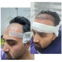 کاشت مو