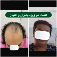 کاشت مو سوزن ۰/۷،کاشت ابرو کره ای(تیم شیراز دریزد)|خدمات آرایشگری و زیبایی|یزد, |دیوار