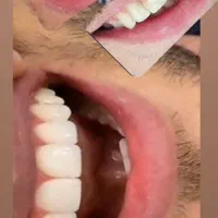 جشنواره کامپوزیت لمینت  بلیچینگ  پالیش دندان