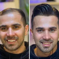 پروتز مو وارداتی ،کاشت hrt|خدمات آرایشگری و زیبایی|اصفهان, گلزار|دیوار