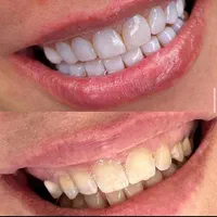 کامپوزیت بدون تراش  باقیمت استثنایی|خدمات آرایشگری و زیبایی|آمل, |دیوار