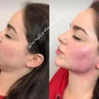 تزریق ژل و بوتاکس|خدمات آرایشگری و زیبایی|بندر کنگان, |دیوار