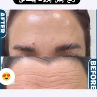 لیزر لک بوتاکس