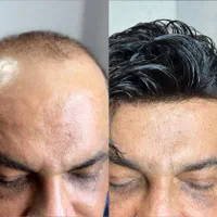 با ۲ میلیون پیش پرداخت صاحب پروتز مو اورجینال شوید|آرایشی، بهداشتی، درمانی|تهران, صادقیه|دیوار