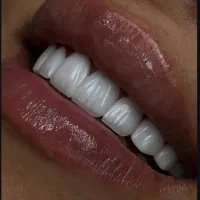 کامپوزیت در اقساط ویژه
