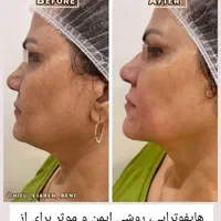 جشنواره تخفیف پلاژن، هایفو،کرایو،ام اسکالپ|خدمات آرایشگری و زیبایی|شیراز, فرهنگ شهر|دیوار