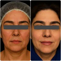 تزریق چربی صورت با ماندگاری ۱۰ ساله - دکتر واحدی|خدمات آرایشگری و زیبایی|قزوین, |دیوار