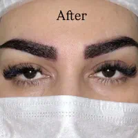 کاشت مو وابرو /لابیاپلاستی.واژینوپلاستی.فیلربیکینی