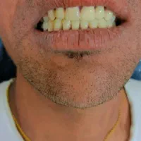 دندان سازی مروارید۳۰٪ اف|خدمات آرایشگری و زیبایی|بهبهان, |دیوار