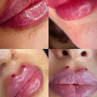 خدمات تزریقات فیلر(ژل)وبوتاکس باپترووآزاد