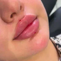 ژل و بوتاکس/ ژل لب/کانتورینگ عربی/روسی