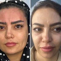 لیفت تخصصی صورت و ابرو فقط امرور با ۴۰ درصد تخفیف|خدمات آرایشگری و زیبایی|شیراز, بعثت|دیوار