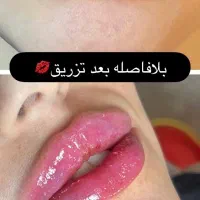 تزریق ژل وبوتاکس آموزش ژل وبوتاکس آنزیم فیلربادی|خدمات آرایشگری و زیبایی|کرمانشاه, |دیوار
