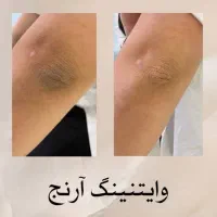 سفیدکردن‌نواحی تیره بدن|خدمات آرایشگری و زیبایی|ارومیه, |دیوار