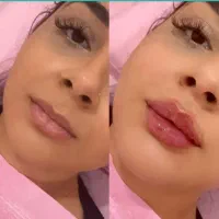 ژل لب ،فیلر،بوتاکس، مزو و جوانسازی،کانتورینگ