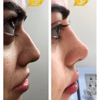 تزریق آنزیم و فیلر بینی|خدمات آرایشگری و زیبایی|تهران, پاسداران|دیوار