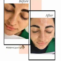 فیشال تخصصی پاکسازی و مزو مو آف پاییزی