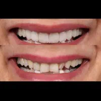 دندانپزشکی عصب کشی اقساط کامپوزیت کشیدن روکش ترمین