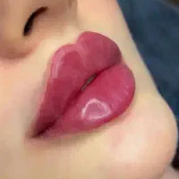 تخفیفات 50 درصدی تزریق فیلر لب و بوتاکس