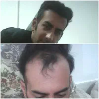 کاشت مو تضمینی واقساط|خدمات آرایشگری و زیبایی|اصفهان, محمودیه|دیوار