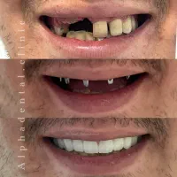 ایمپلنت دندان/لمینت و کامپوزیت/درمان ریشه و ترمیم