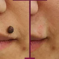 خـالبـرداری راهی برای زیبایی پوست صورت و بدن