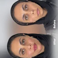 ۵۰٪تخفیف ژل بوتاکس لیفت و ساکشن توسط پزشک