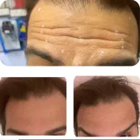 ژل،بوتاکس،پی آرپی،میکرونیدلینگ|خدمات آرایشگری و زیبایی|اصفهان, خانه اصفهان|دیوار