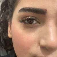 کاشت هیدن رایگان