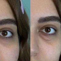 جشنواره ژل لب گونه چونه زاویه فک فیلرزیرچشم بوتاکس|خدمات آرایشگری و زیبایی|تهران, قلهک|دیوار