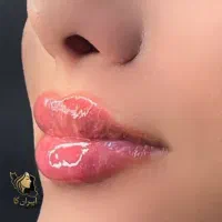 آفر ویژه تزریق فیلر و مزو|خدمات آرایشگری و زیبایی|تهران, تهرانپارس جنوبی|دیوار