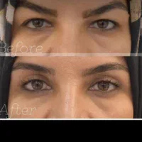 بلفاروپلاستی و ساکشن غبغب آفر ویژه