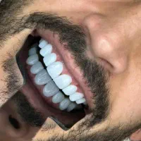 جشنواره کامپوزیت ونیر لمینیت روکش عصب ترمیم IMAX|خدمات آرایشگری و زیبایی|تهران, پاسداران|دیوار