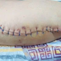 خدمات پرستاری و تزریقات در منزل محمودآباد