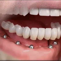 خط لبخند دندان های زیبا با قیمت باور نکردنی