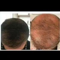 مشاوره رایگان ریزش مو،رویش،نازکی،کم پشتی،سکه ای