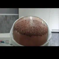 همکاری با تکنسین کاشت مو ابرو در کلینیک معتبر