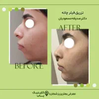 تزریق فیلر زیر چشم|خدمات آرایشگری و زیبایی|تهران, جردن|دیوار