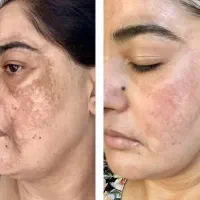 به مدل جهت انجام تکنیک آیینه سازی پوست|خدمات آرایشگری و زیبایی|ورامین, ورامین|دیوار